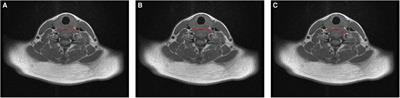 MRI-Based Optimization Design of the Pre-Spinal Route of Contralateral C7 Nerve Transfer for Spastic Arm Paralysis